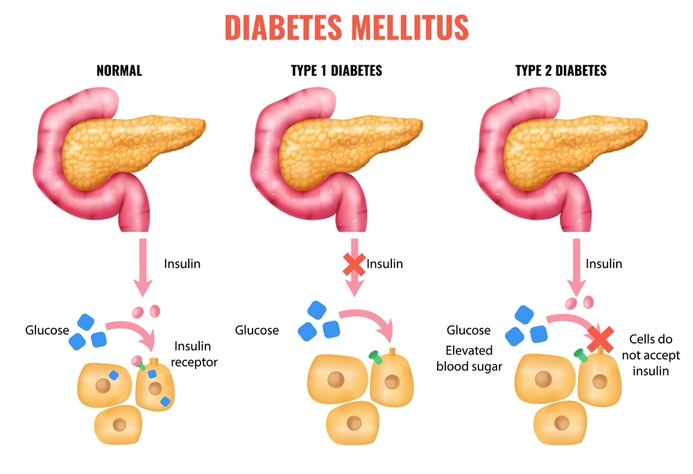 What You Need To Know Stages of Type 2 Diabetes Diabetes