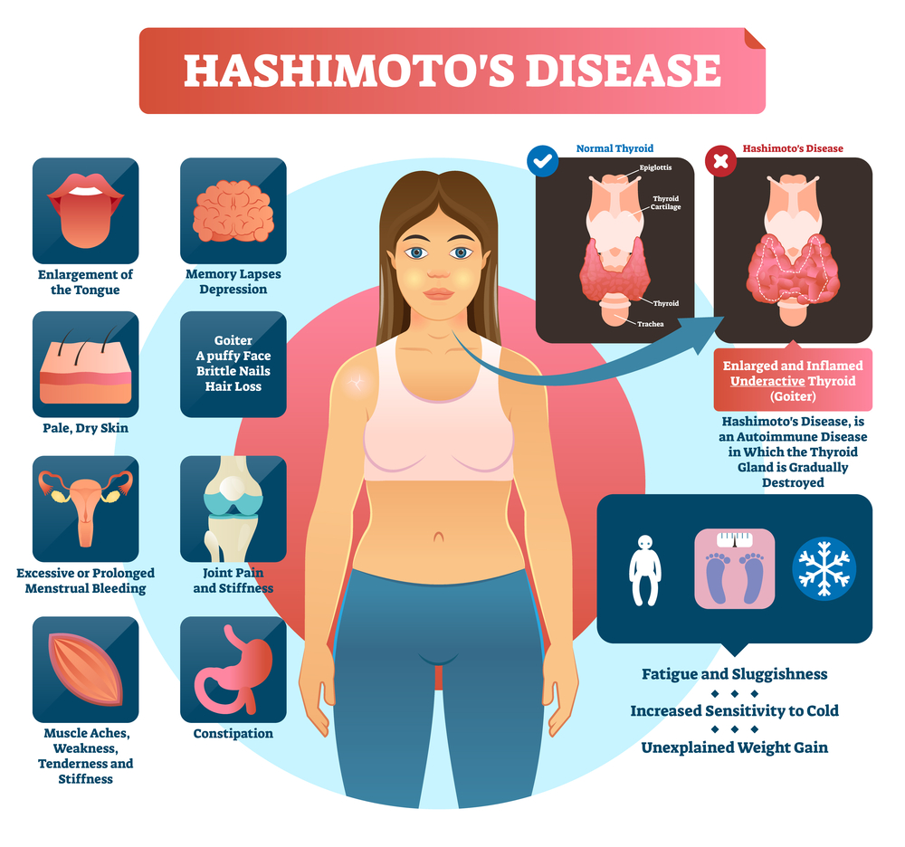 Learning To Live With Hashimoto s Thyroiditis Diabetes Endocrine 